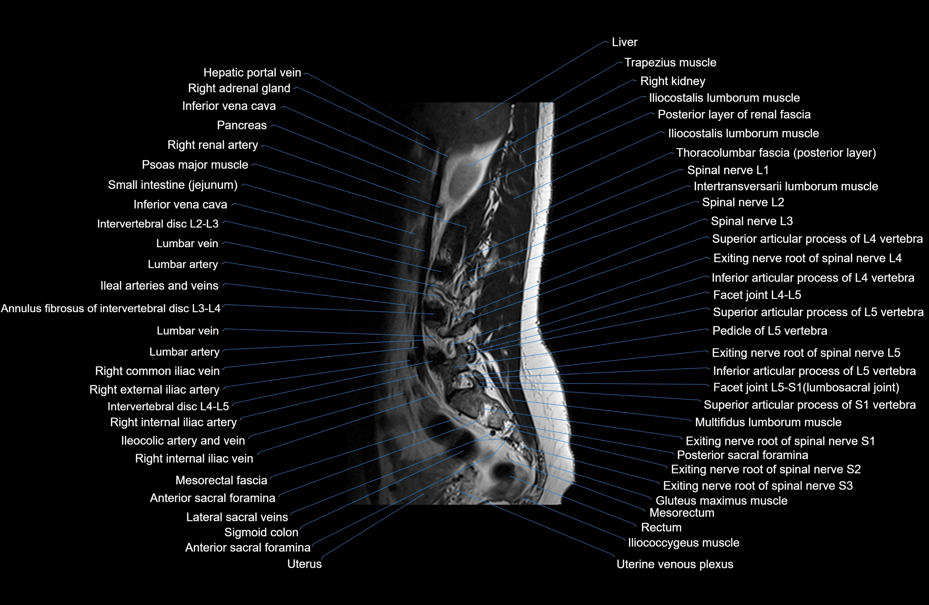 MRI lumbar spine sagittal cross sectional anatomy 3T radiology  image-img-00001-00005.webp
